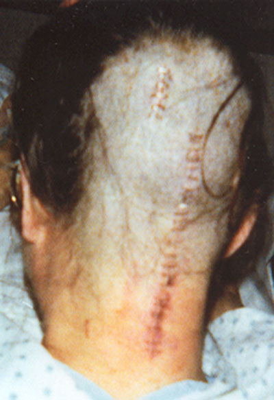 LJ Fullerton Brain Surgery January 14, 1997